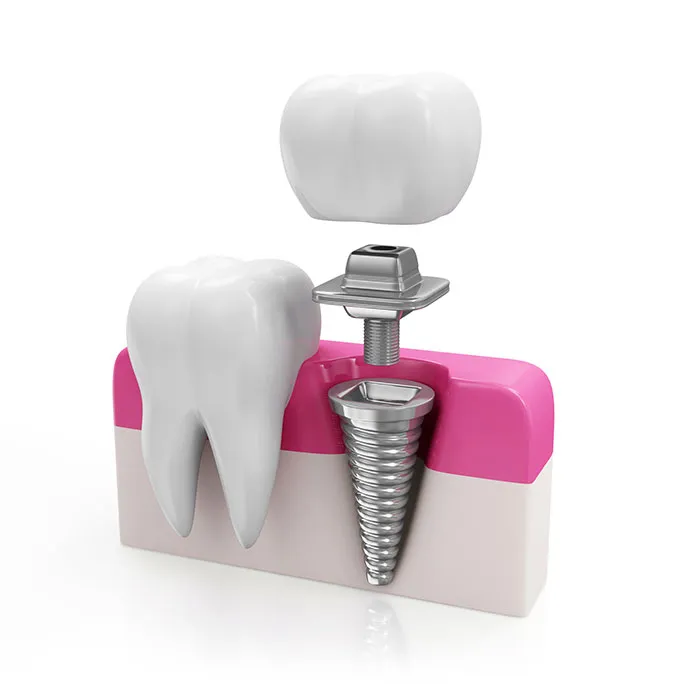What are Dental Implants?