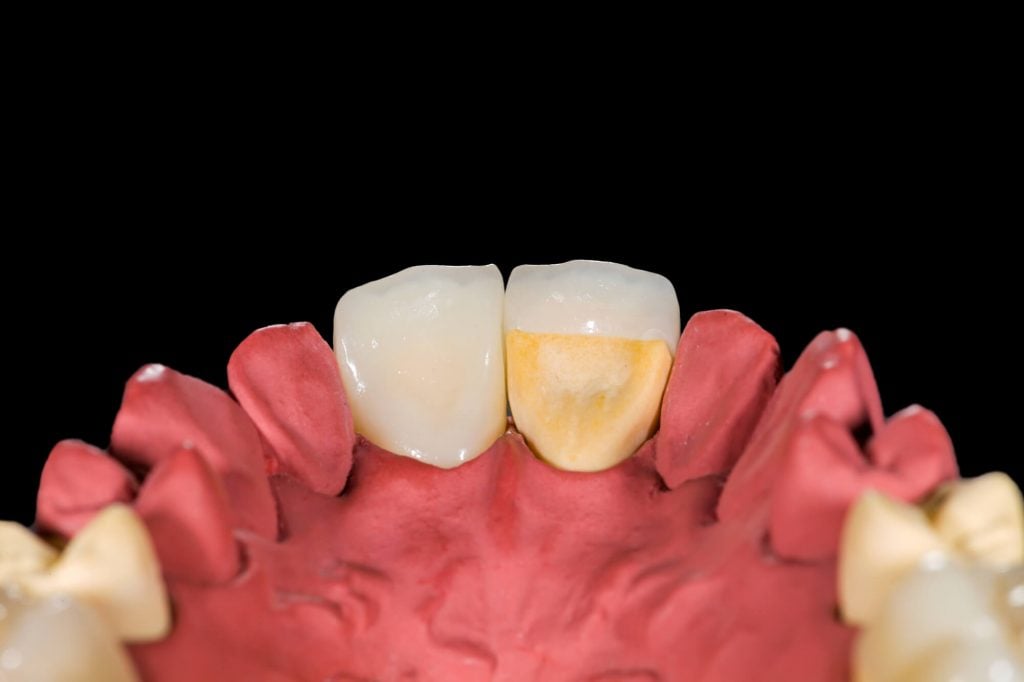 A Tooth with Dental Crowns in Fort Pierce