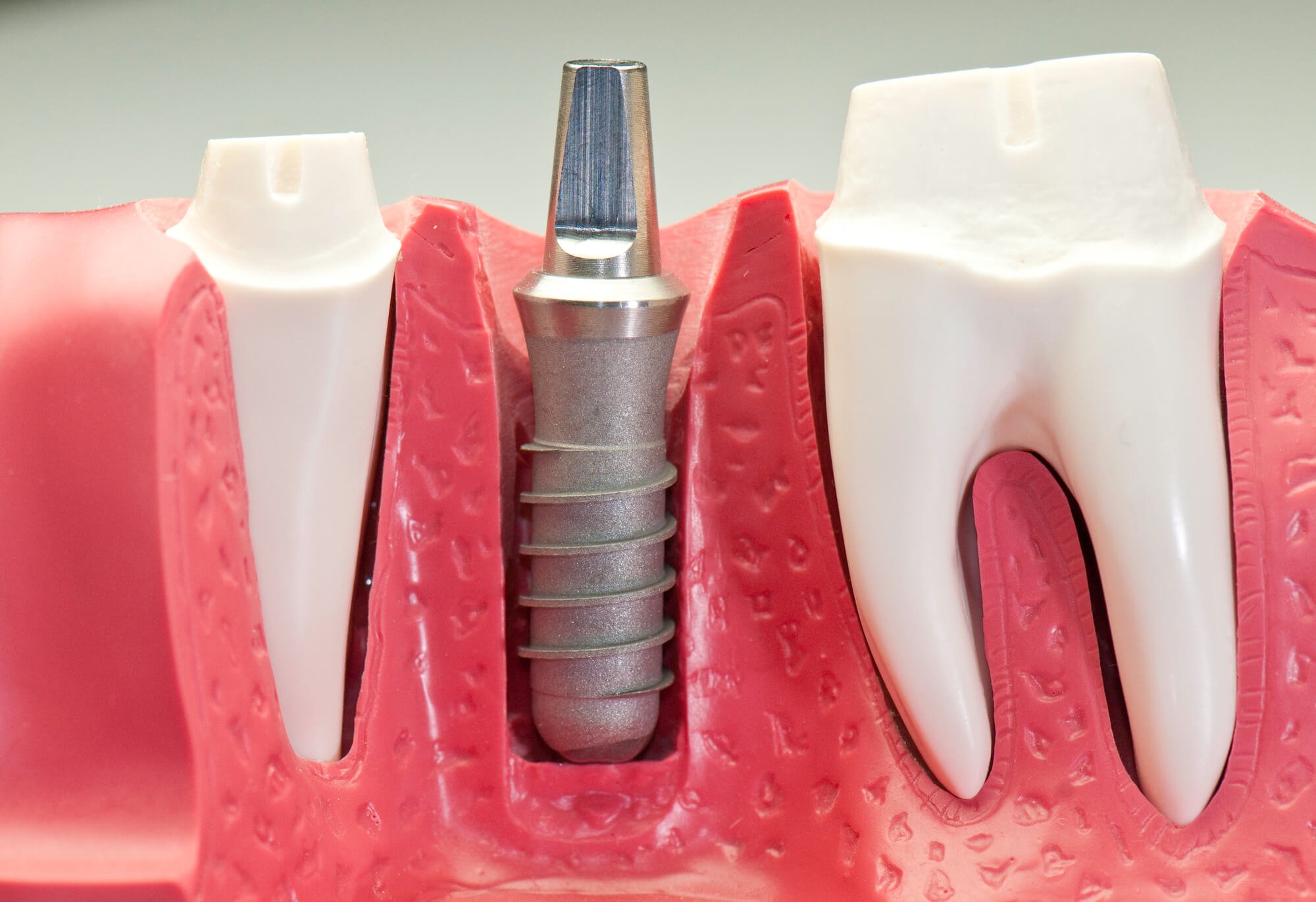 Illustration of Dental Implants in Fort Pierce