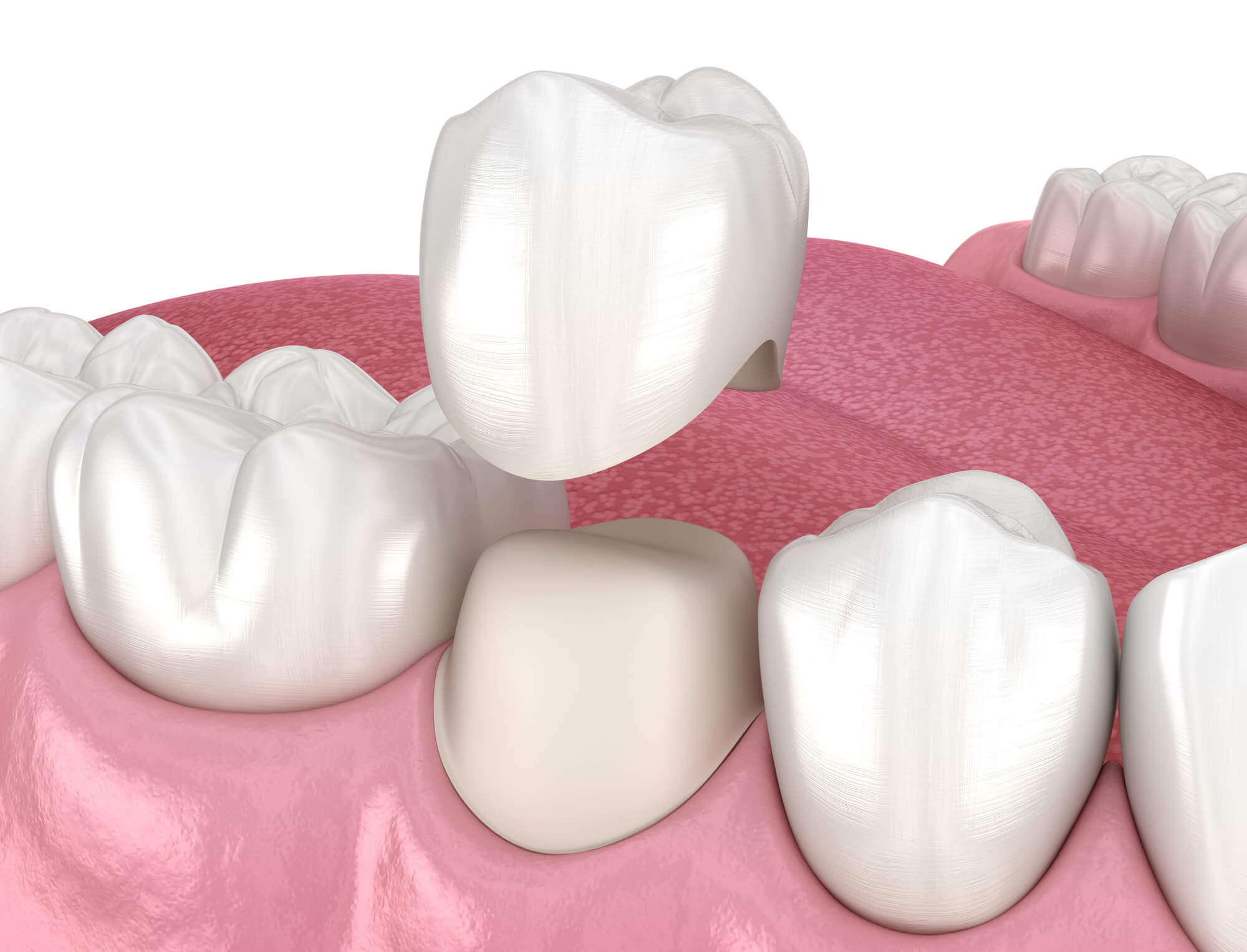 3D image of Dental Crowns in Fort Pierce
