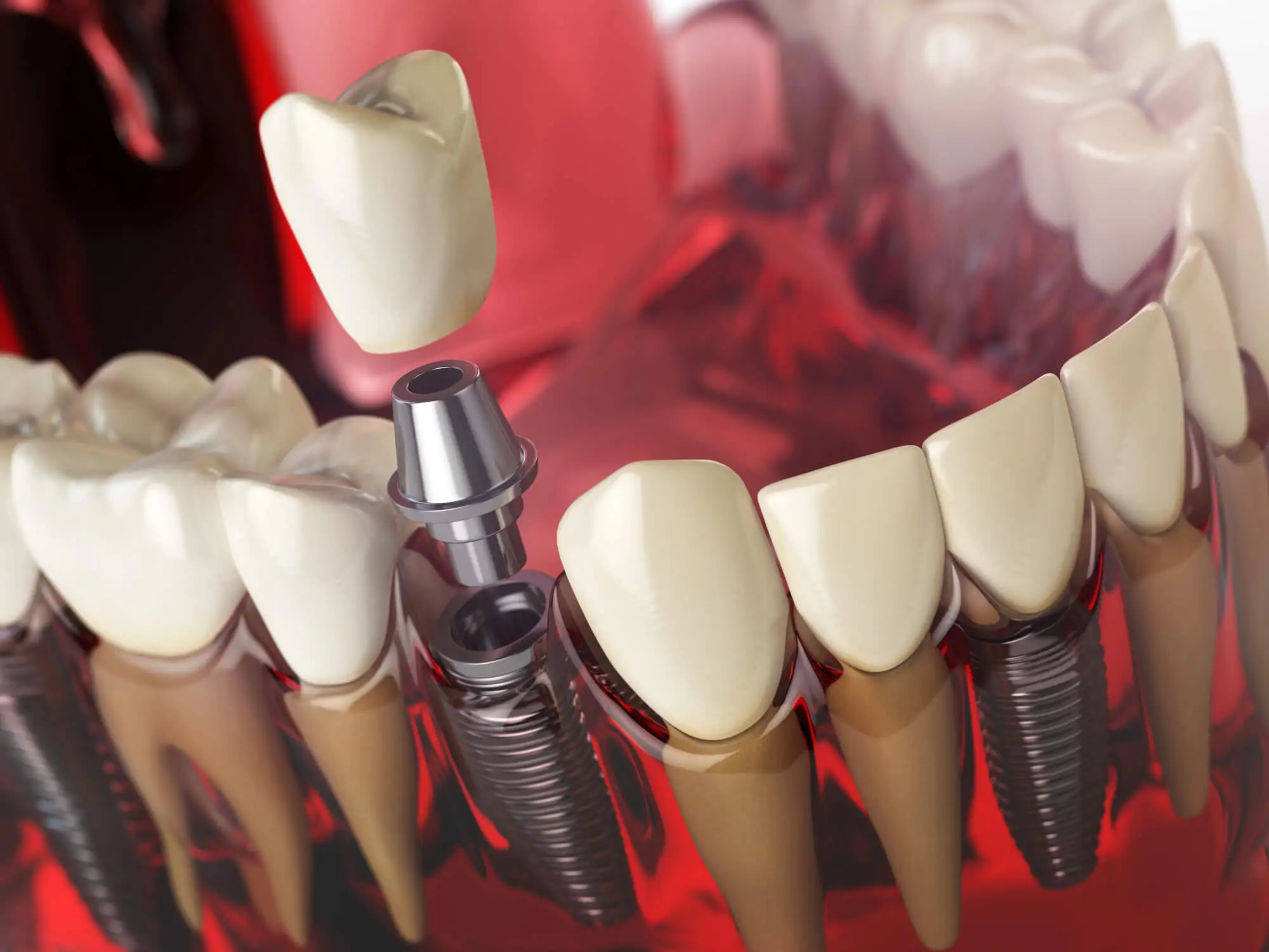 Illustration of Port St. Lucie Dental Implants