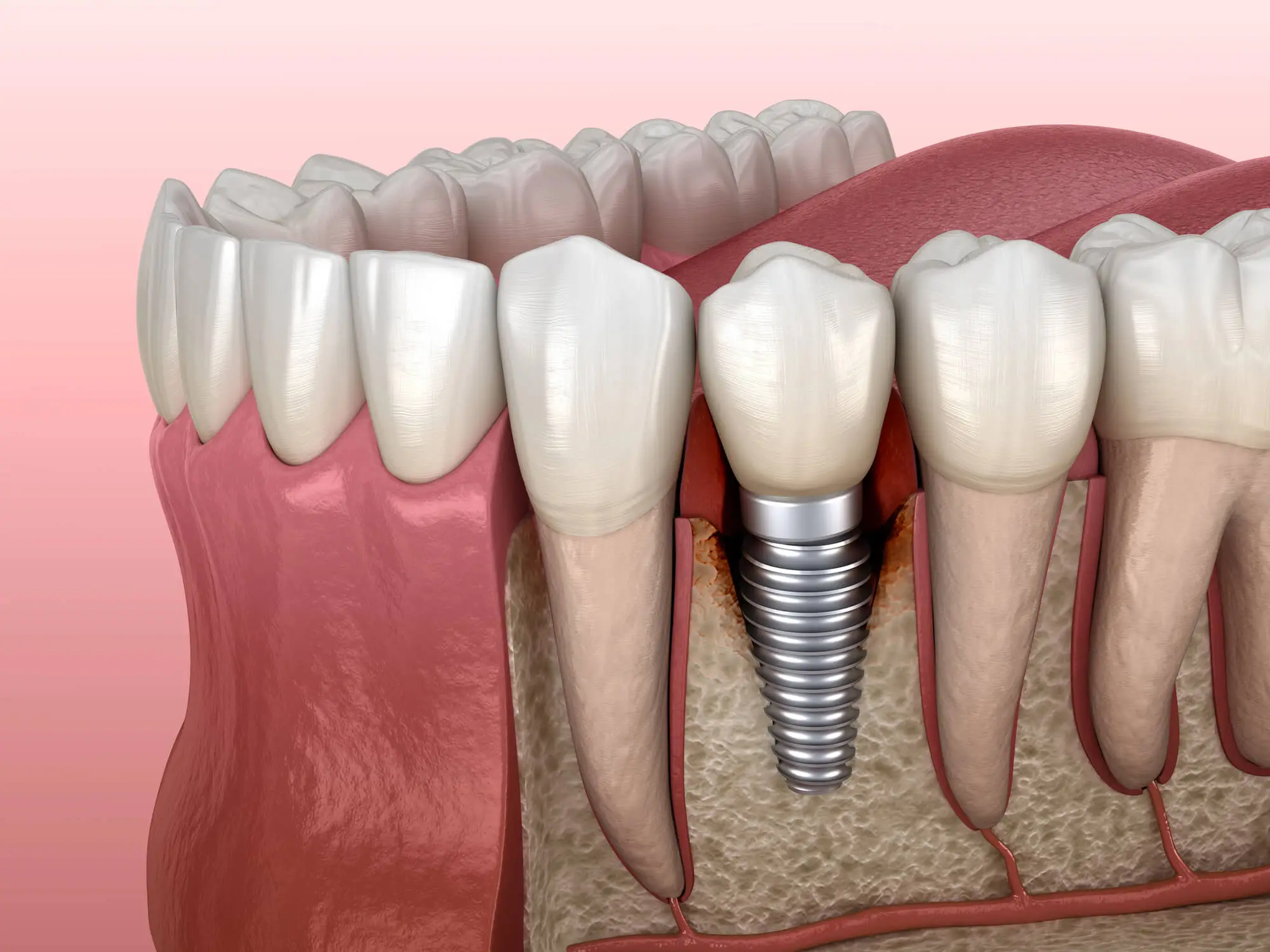 Illustration of Dental Implants in Fort Pierce with Peri Implantitis