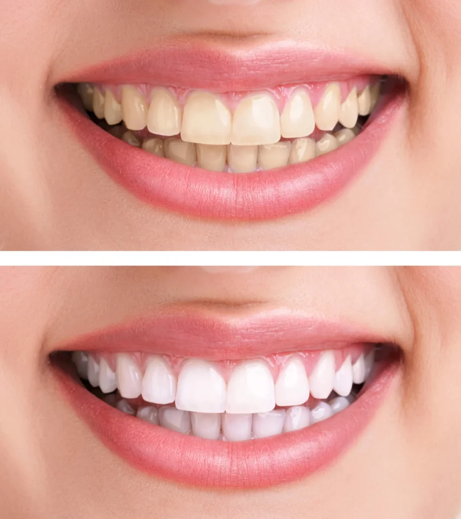 Before and after teeth whitening results, teeth whitening in Fort Pierce
