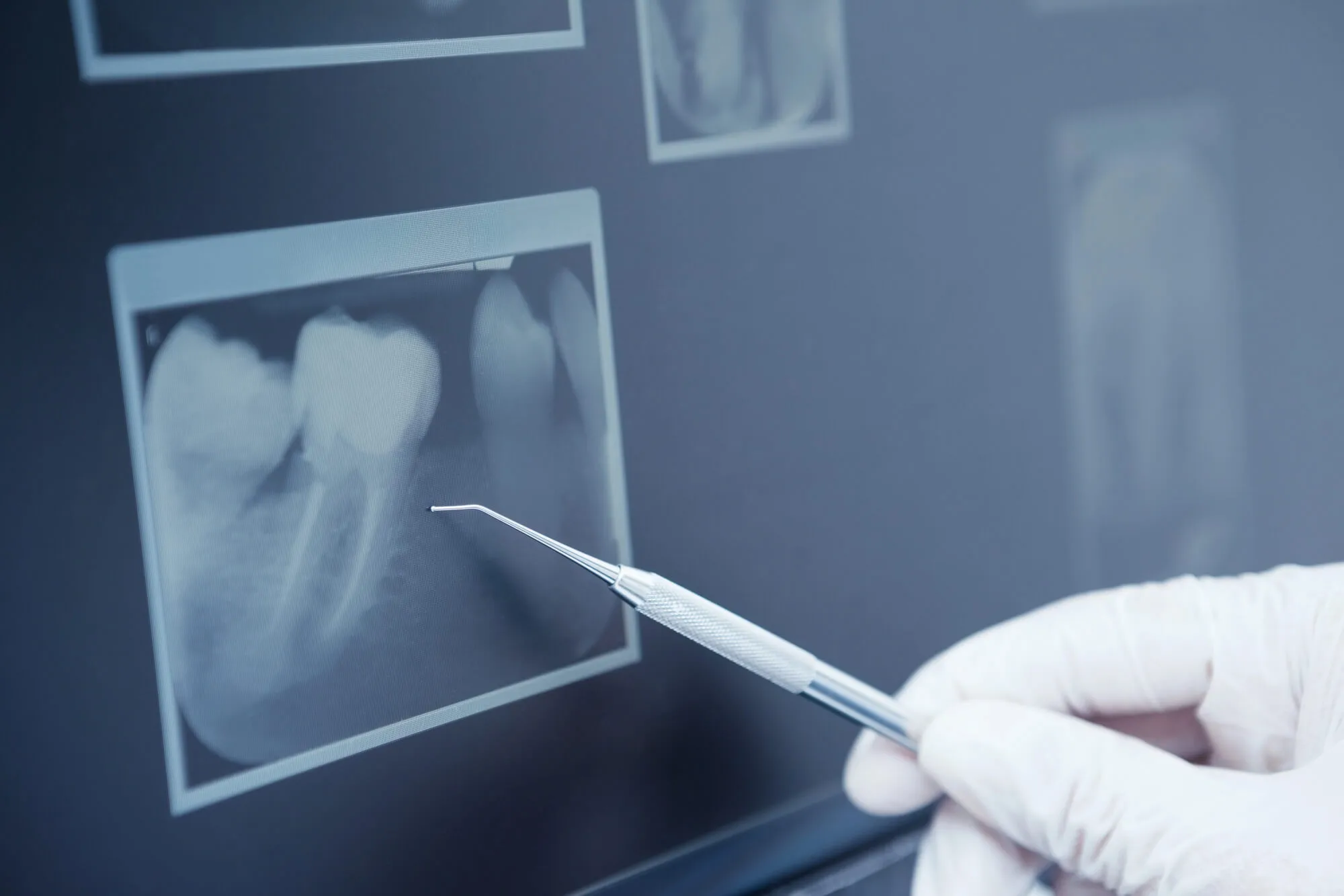 Dental Bridges Fort Pierce That Prevent Bone Resoprtion