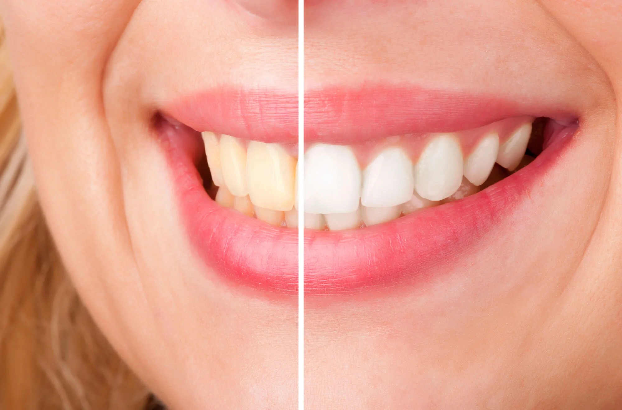 Before and after teeth whitening results cosmetic dentist in Fort Pierce