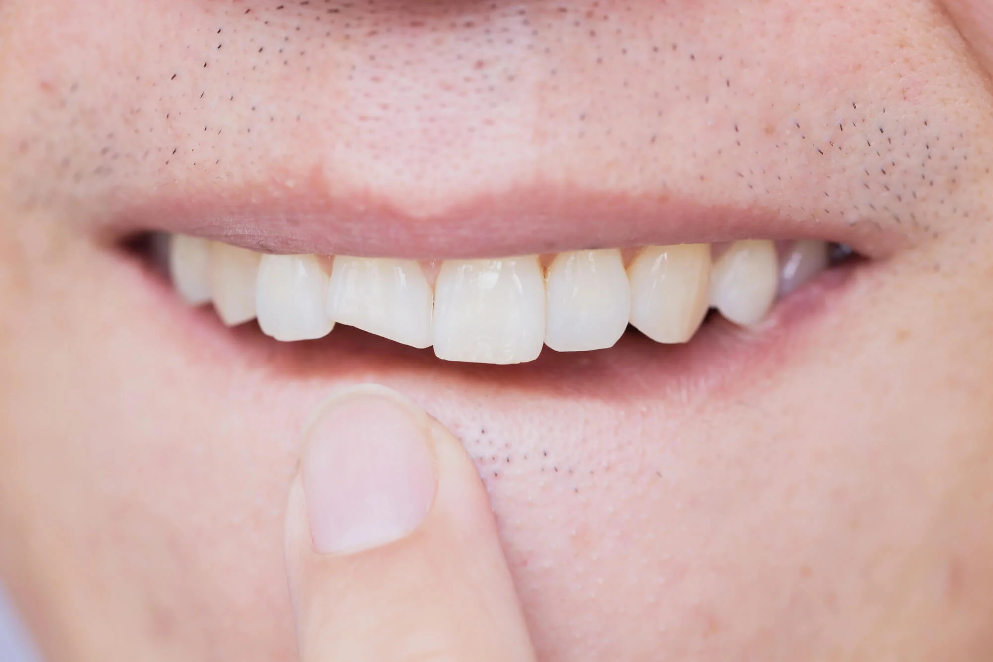 Close-up of chipped front tooth, dentist in Indian River