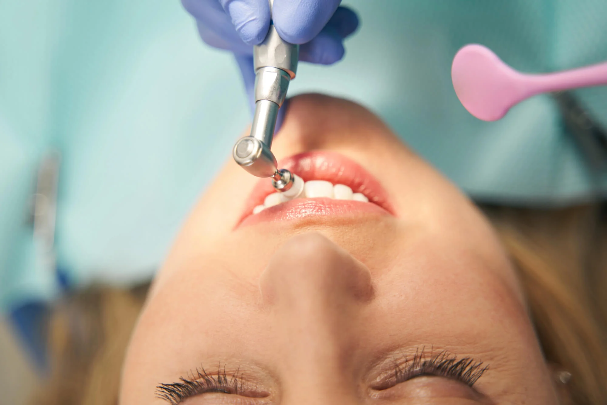 Dental cleaning procedure close-up emergency dentist in Fort Pierce