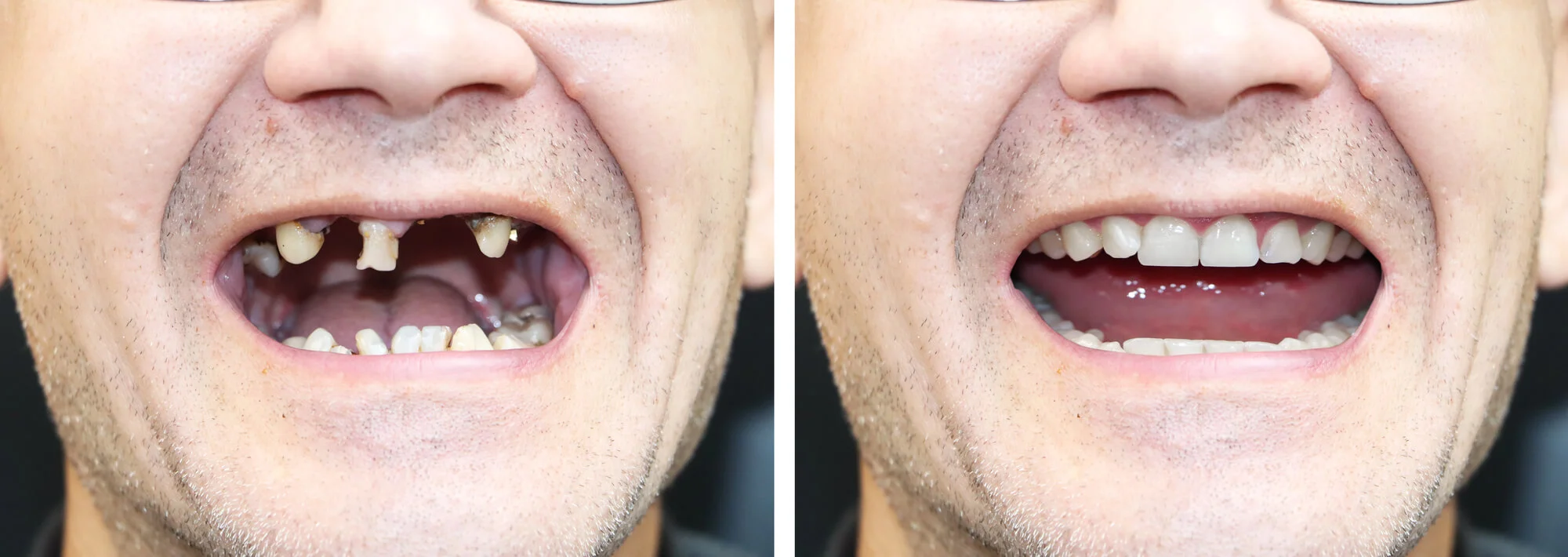 Before and after smile with dental implants in Vero Beach