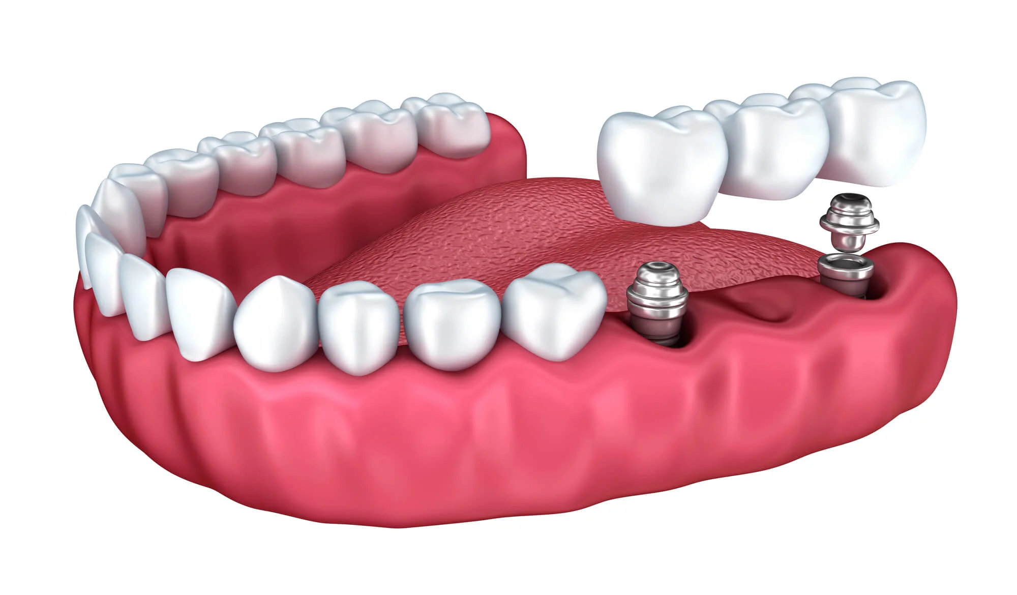 Dental implant bridge illustration dental implants in Port St. Lucie