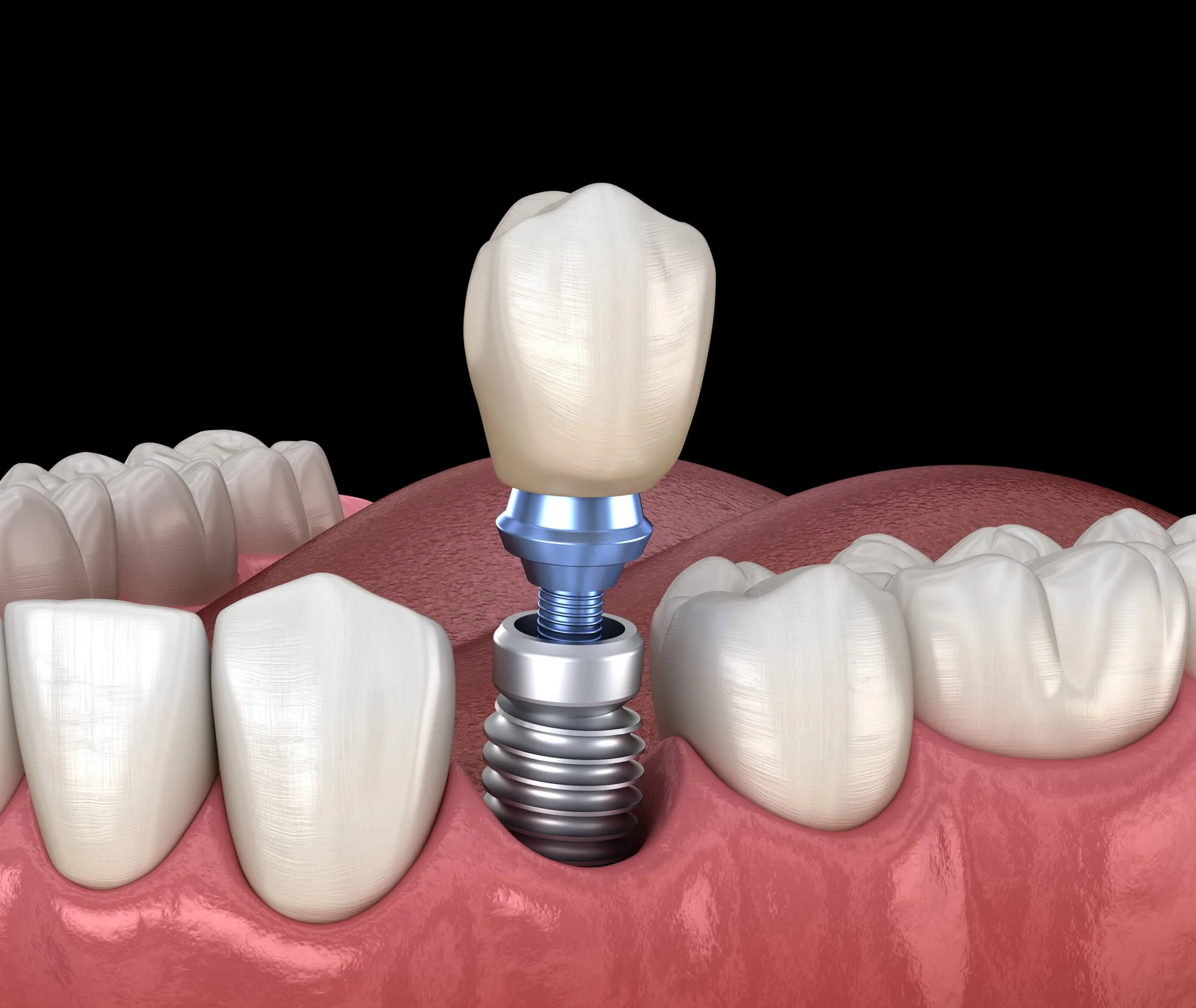 Single dental implant close-up dental implants in Port St. Lucie