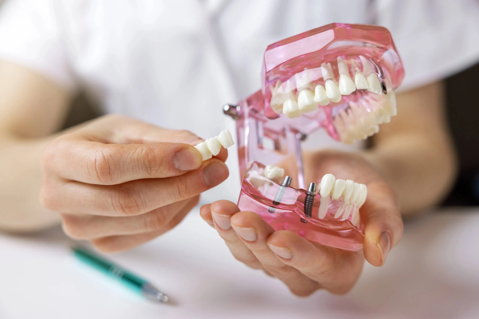 Dental Bridges Fort Pierce Model shown by Dentist