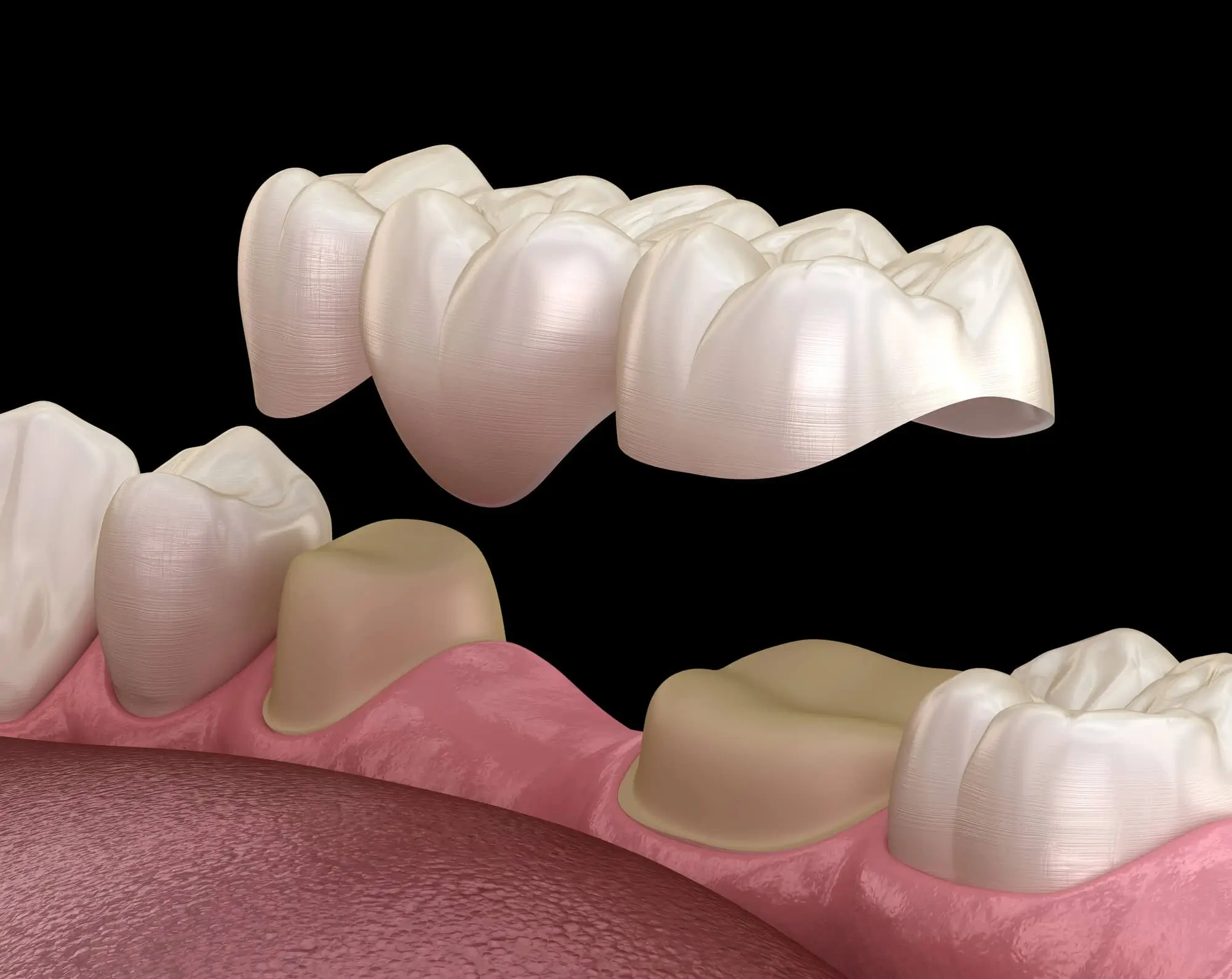 Dental Bridges Fort Pierce