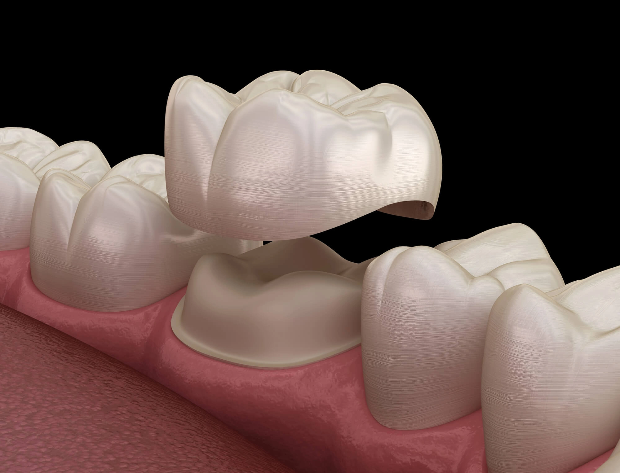 Dental-Crowns-Fort-Pierce