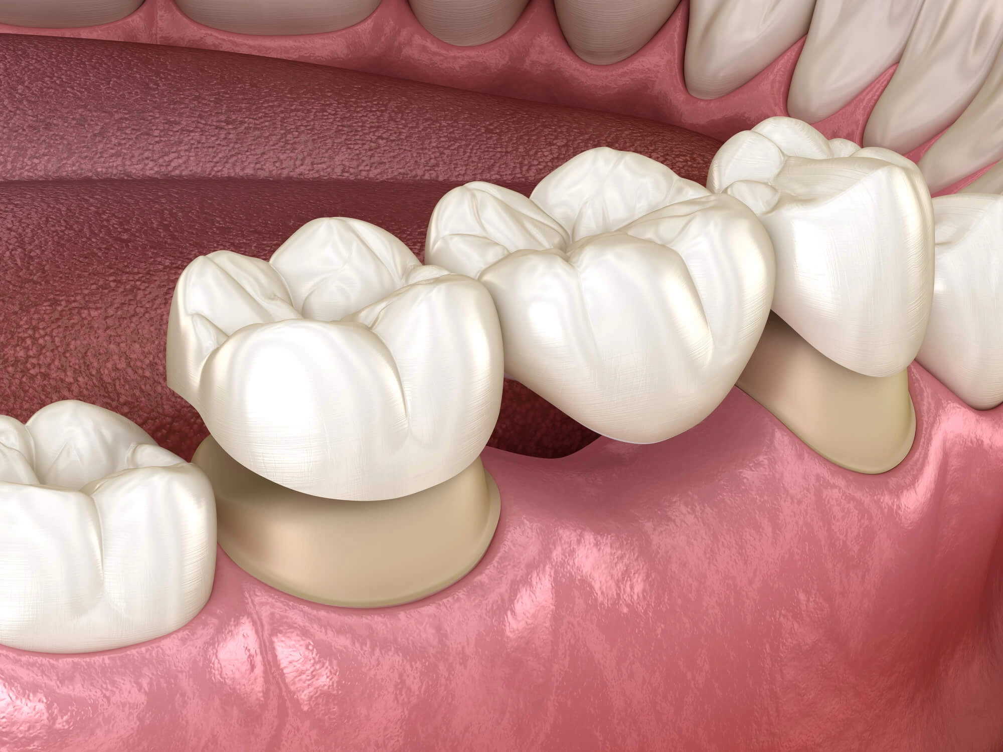 3D Illustration of bridges by Best Dentist in Fort Pierce