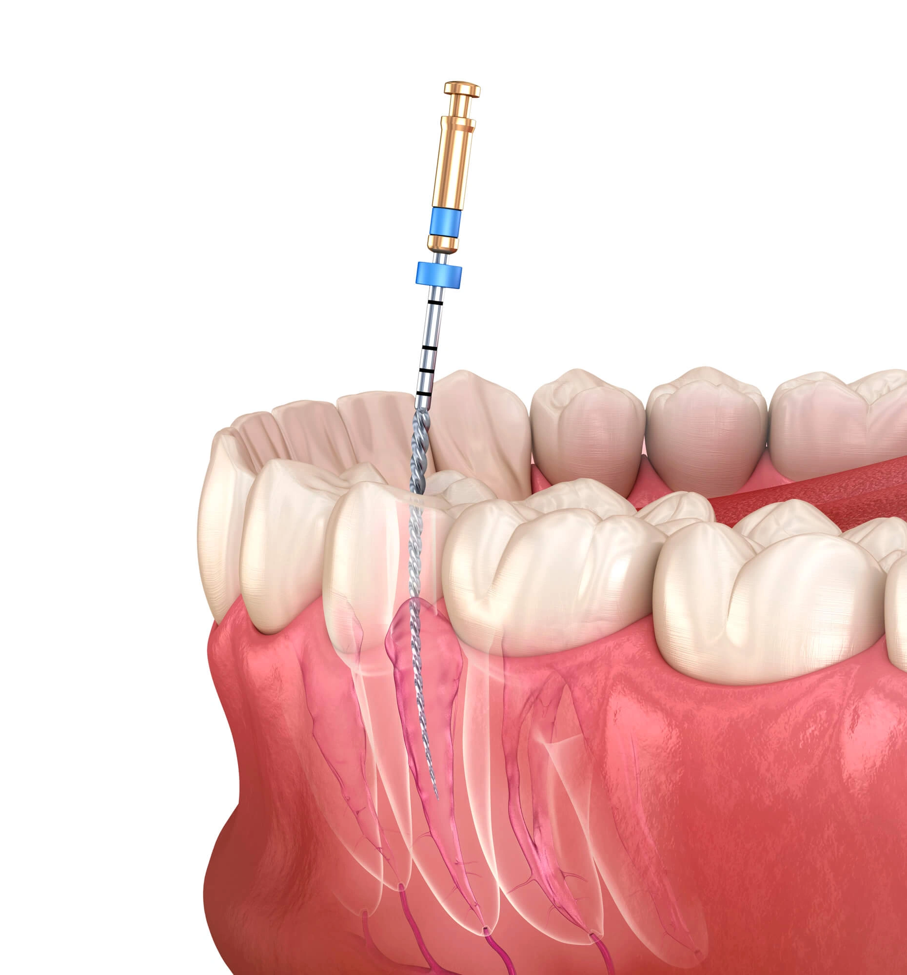 Ft. Pierce Dentist 3D illustration of Root canal