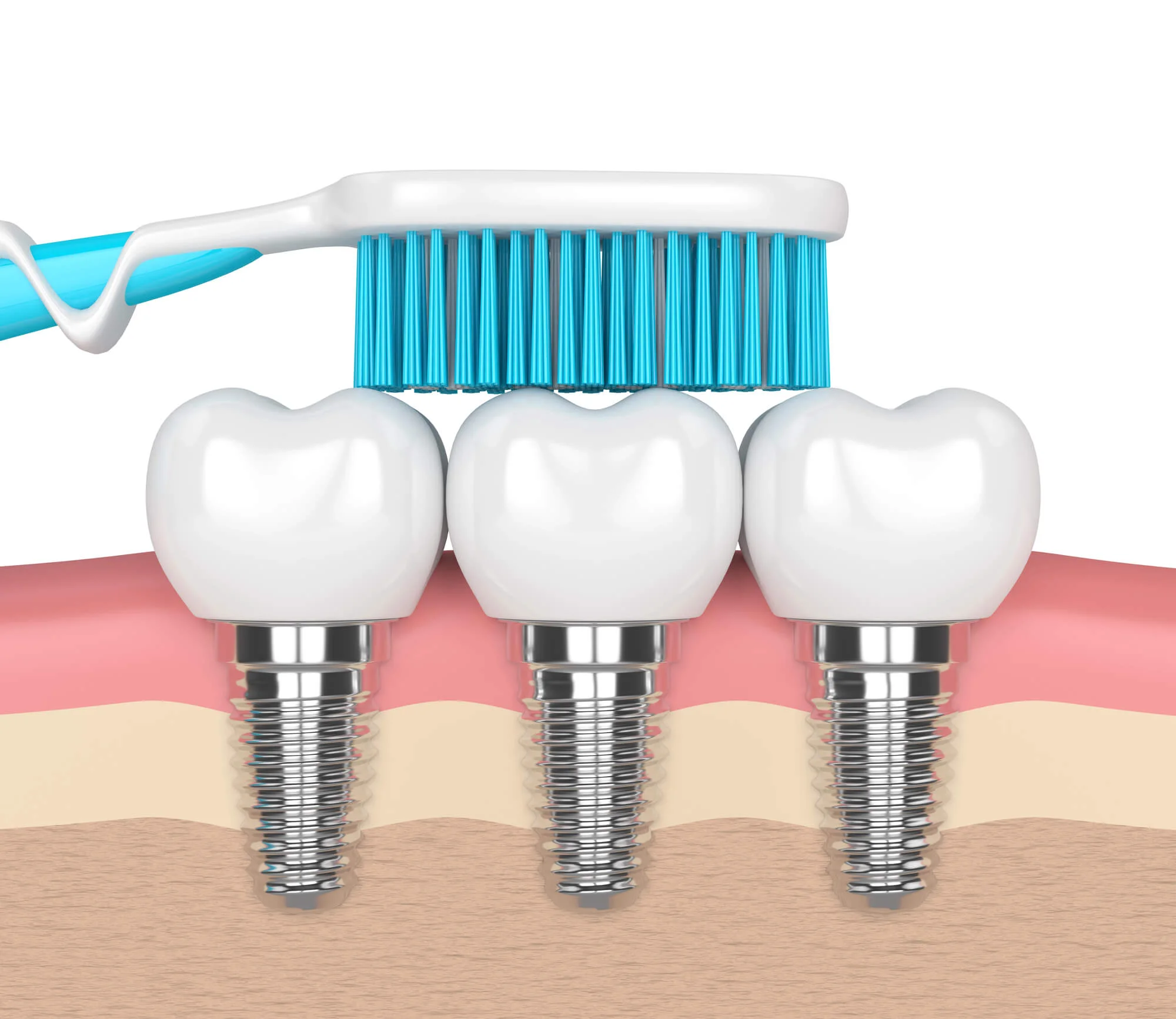Brushing Vero Beach Dental Implants
